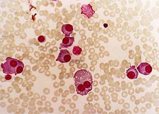 Breakthrough Therapy Designation was granted for bb2121, a novel CAR T-cell therapy indicated for patients with multiple myeloma who have undergone previous treatments. Breakthrough Therapy Designation was granted for bb2121, a novel CAR T-cell therapy indicated for patients with multiple myeloma who have undergone previous treatments.