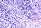 Adjuvant Bevacizumab Does Not Increase Survival in High-Risk Melanoma Adjuvant Bevacizumab Does Not Increase Survival in High-Risk Melanoma