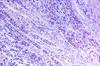 Distinct Patterns of Shiny White Streaks Strong Indicator of Melanoma Distinct Patterns of Shiny White Streaks Strong Indicator of Melanoma
