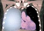 Research Shows Drug Inhibits Mesothelioma Growth Research Shows Drug Inhibits Mesothelioma Growth