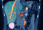 Oncology Nurses Ideal for Educating Patients on Portal Vein Thrombosis Oncology Nurses Ideal for Educating Patients on Portal Vein Thrombosis
