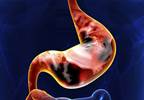 Breath Test Might Assist Detection of Stomach and Esophageal Cancers Breath Test Might Assist Detection of Stomach and Esophageal Cancers