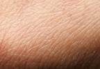 Silicone dressing prevents skin reactions during radiation Silicone dressing prevents skin reactions during radiation