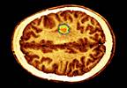 New WHO Glioma Classification Can 'Optimize Patient Treatment Going Forward' New WHO Glioma Classification Can 'Optimize Patient Treatment Going Forward'