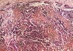 Adding Doxorubicin to Sorafenib Does Not Improve Overall Survival in Hepatocellular Carcinoma Adding Doxorubicin to Sorafenib Does Not Improve Overall Survival in Hepatocellular Carcinoma