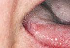 Cisplatin, Cetuximab Show Similar Locoregional Control in Unresectable Head and Neck Cancer Cisplatin, Cetuximab Show Similar Locoregional Control in Unresectable Head and Neck Cancer