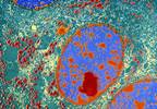Potential Survival Advantage Observed for 177Lu-Dotatate in Midgut Neuroendocrine Tumors Potential Survival Advantage Observed for 177Lu-Dotatate in Midgut Neuroendocrine Tumors