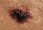 Pembrolizumab Demonstrates Long-Term Survival in Advanced Melanoma Pembrolizumab Demonstrates Long-Term Survival in Advanced Melanoma