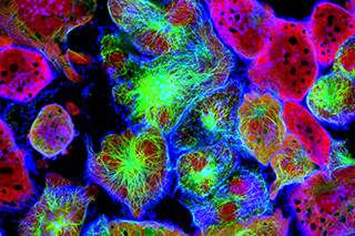 Alterations in Metabolic Pathways in Prostate Cancer Hint at Potential New Treatments Alterations in Metabolic Pathways in Prostate Cancer Hint at Potential New Treatments