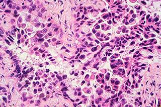 Researchers assessed disease progression following first-line anticancer therapy. Researchers assessed disease progression following first-line anticancer therapy.