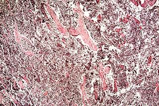 Researchers evaluated the combined effect of chemotherapy and atezolizumab in treating extensive-stage SCLC. Researchers evaluated the combined effect of chemotherapy and atezolizumab in treating extensive-stage SCLC.