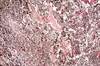 Early Checkpoint Inhibition With Cytotoxic Chemotherapy Improves OS, PFS in Extensive-Stage SCLC Early Checkpoint Inhibition With Cytotoxic Chemotherapy Improves OS, PFS in Extensive-Stage SCLC