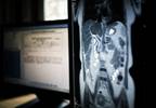 Aspirin Use Found to Prevent Cholangiocarcinoma Aspirin Use Found to Prevent Cholangiocarcinoma