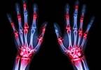 Case Reports Show an Association Between Immune Checkpoint Inhibitors and Risk for Rheumatologic Disorders Case Reports Show an Association Between Immune Checkpoint Inhibitors and Risk for Rheumatologic Disorders