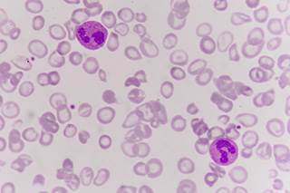 Enlarged blood cells Enlarged blood cells