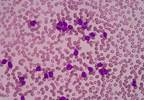 Tyrosine Kinase Inhibitor Therapy Can Be Safely Stopped in Select Patients With CML in Chronic Phase Tyrosine Kinase Inhibitor Therapy Can Be Safely Stopped in Select Patients With CML in Chronic Phase