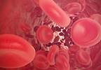 A Case of Newly Diagnosed PCV After Relapse TTP Complicated by Undiagnosed RA A Case of Newly Diagnosed PCV After Relapse TTP Complicated by Undiagnosed RA
