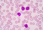 Ofatumumab With Fludarabine, Cyclophosphamide Approved for Relapsed CLL Ofatumumab With Fludarabine, Cyclophosphamide Approved for Relapsed CLL