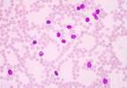 Chronic Lymphocytic Leukemia (Fact Sheet) Chronic Lymphocytic Leukemia (Fact Sheet)