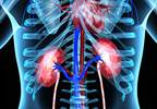 Hydroxyurea May Improve Kidney Function in PV-Associated Nephrotic Syndrome Hydroxyurea May Improve Kidney Function in PV-Associated Nephrotic Syndrome