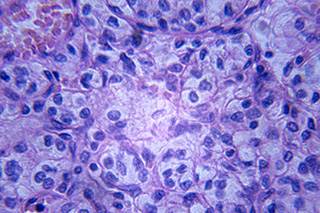Patients with advanced RCC who discontinued anti-PD-1/PD-L1 immunotherapy early may still achieve durable responses. Patients with advanced RCC who discontinued anti-PD-1/PD-L1 immunotherapy early may still achieve durable responses.