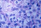 Adjuvant Girentuximab Not Effective for Renal Cell Carcinoma Adjuvant Girentuximab Not Effective for Renal Cell Carcinoma