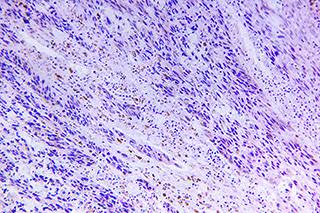 PD-1 Inhibitors Ideal for First-Line Therapy in Treatment-Naïve Advanced Melanoma PD-1 Inhibitors Ideal for First-Line Therapy in Treatment-Naïve Advanced Melanoma
