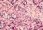 Current Findings in Trial Evaluating Paclitaxel Substitution in Invasive Breast Cancer Current Findings in Trial Evaluating Paclitaxel Substitution in Invasive Breast Cancer
