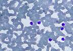 Polycythemia Vera (Fact Sheet) Polycythemia Vera (Fact Sheet)
