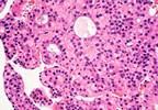 Durable Response Seen in Advanced HCC With Nivolumab Durable Response Seen in Advanced HCC With Nivolumab