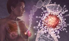 Risk calculator assesses patients for risk of persistent pain after breast cancer surgery (PPBCS). Risk calculator assesses patients for risk of persistent pain after breast cancer surgery (PPBCS).