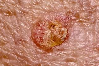 Actinic keratosis is caused by years of sun exposure. Actinic keratosis is caused by years of sun exposure.
