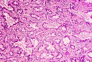 Per independent review, alectinib extended the NSCLC median time to progression by approximately 15 months. Per independent review, alectinib extended the NSCLC median time to progression by approximately 15 months.