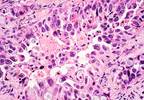 Nivolumab Provides Better Long-Term Efficacy Compared With Docetaxel in NSCLC Nivolumab Provides Better Long-Term Efficacy Compared With Docetaxel in NSCLC