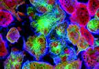 MABp1 Improves Symptoms vs Placebo in Colorectal Cancer MABp1 Improves Symptoms vs Placebo in Colorectal Cancer