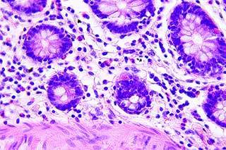 Doxorubicin is highly effective for colorectal cancer treatment, but cardiotoxicity remains an issue. Doxorubicin is highly effective for colorectal cancer treatment, but cardiotoxicity remains an issue.