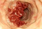 Treatment for Young Adults With GIST May Differ From Older Adults GIST Patients Treatment for Young Adults With GIST May Differ From Older Adults GIST Patients