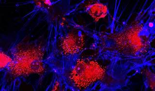 A nurse-led team developed a tracking tool that created a vaccination schedule from transplant date forward for autologous hematopoietic stem cell transplant recipients. A nurse-led team developed a tracking tool that created a vaccination schedule from transplant date forward for autologous hematopoietic stem cell transplant recipients.