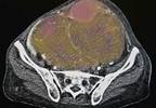 HMT Improves PFS in Serous Carcinoma of the Ovary, Peritoneum HMT Improves PFS in Serous Carcinoma of the Ovary, Peritoneum