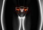 Adding Bevacizumab to First-line Chemotherapy Benefits Selects Cases of Ovarian Cancer Adding Bevacizumab to First-line Chemotherapy Benefits Selects Cases of Ovarian Cancer