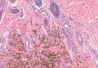 Melanoma Outcomes Improved With Nivolumab Alone or Plus Ipilimumab Melanoma Outcomes Improved With Nivolumab Alone or Plus Ipilimumab