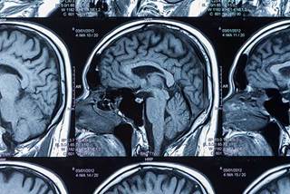 NBTS launched a clinical trial finder specific to brain tumors to engage patients in research and clinical trials. NBTS launched a clinical trial finder specific to brain tumors to engage patients in research and clinical trials.