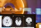 Temozolomide With Radiotherapy for Glioblastoma Provides Some Survival Benefit in Elderly Temozolomide With Radiotherapy for Glioblastoma Provides Some Survival Benefit in Elderly