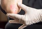 Psoriasis May Increase Risk of Melanoma and Hematologic Cancers Psoriasis May Increase Risk of Melanoma and Hematologic Cancers