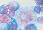 Incidence of Invasive Cervical Cancer May Not Be Affected by HIV Status Incidence of Invasive Cervical Cancer May Not Be Affected by HIV Status