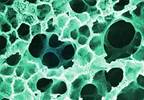 Importance of GM-CSF Autoantibodies in Pulmonary Alveolar Proteinosis With MPN Importance of GM-CSF Autoantibodies in Pulmonary Alveolar Proteinosis With MPN