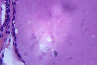 Two FDA-approved melanoma therapies may prove useful in treating BRAF-mutated papillary thyroid cancer. Two FDA-approved melanoma therapies may prove useful in treating BRAF-mutated papillary thyroid cancer.