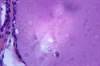 Immunotherapy May Benefit Some Patients with Papillary Thyroid Carcinoma Immunotherapy May Benefit Some Patients with Papillary Thyroid Carcinoma