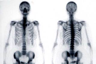 More than 400 thousand bone scintigraphy studies were performed for Medicare patients in 2014. More than 400 thousand bone scintigraphy studies were performed for Medicare patients in 2014.