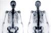New Criteria for Appropriate Use of Bone Scintigraphy to Diagnose and Manage Prostate and Breast Cancer New Criteria for Appropriate Use of Bone Scintigraphy to Diagnose and Manage Prostate and Breast Cancer
